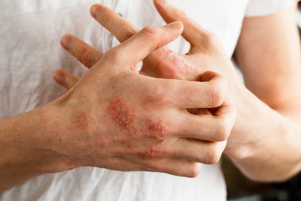 3 Treatments to Help People With Moderate to Severe Eczema